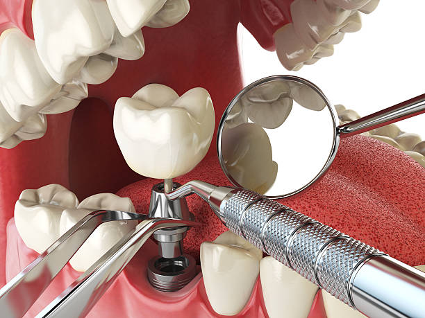 Best Dentist for Tooth Abscess  in South Park, WY